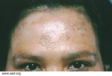 Fight Sunspots and Melasma with a Chemical Peel - Dontage